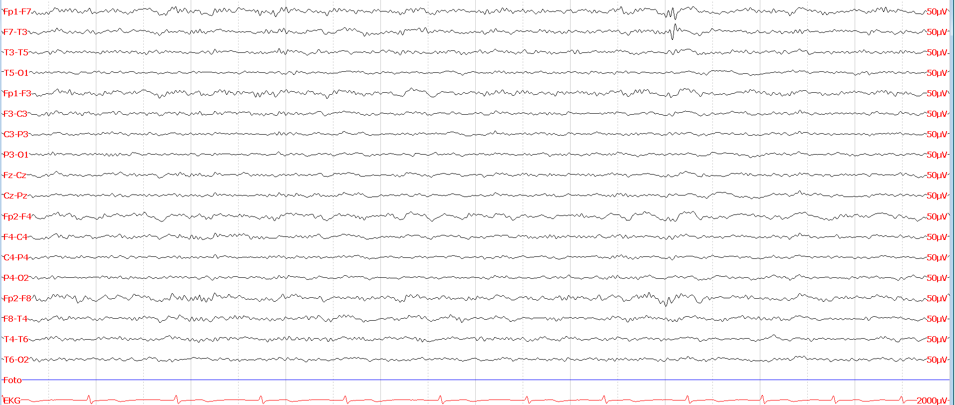 EEG graf, ukázka, Neurologie Mištríková